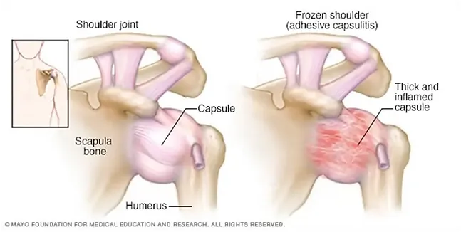 Anatomical illustration of frozen shoulder showing inflammation and restricted movement in the shoulder joint capsule