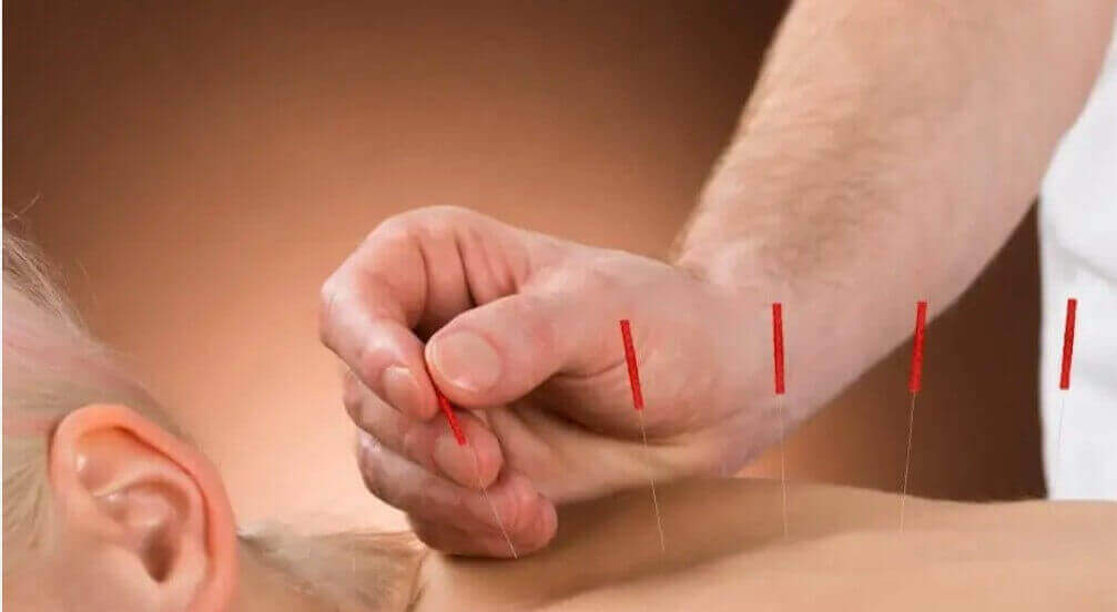 Licensed acupuncture treatment by RMT in Scarborough – Massage Well4U Clinic